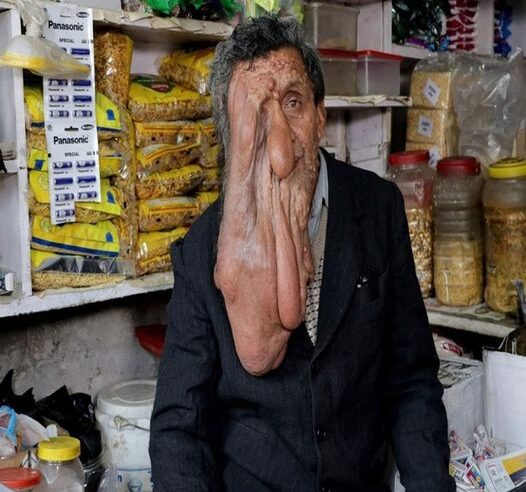 Resilience in Adversity: The Inspiring Journey of a Grocer with a Sagging Face