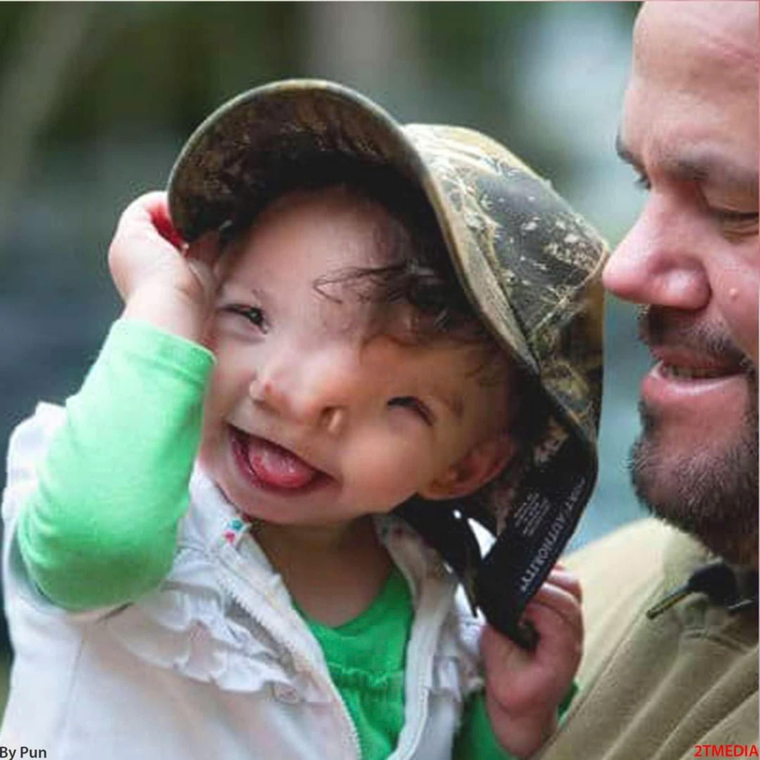 Understanding the Condition: Boy with Two Nostrils Fused