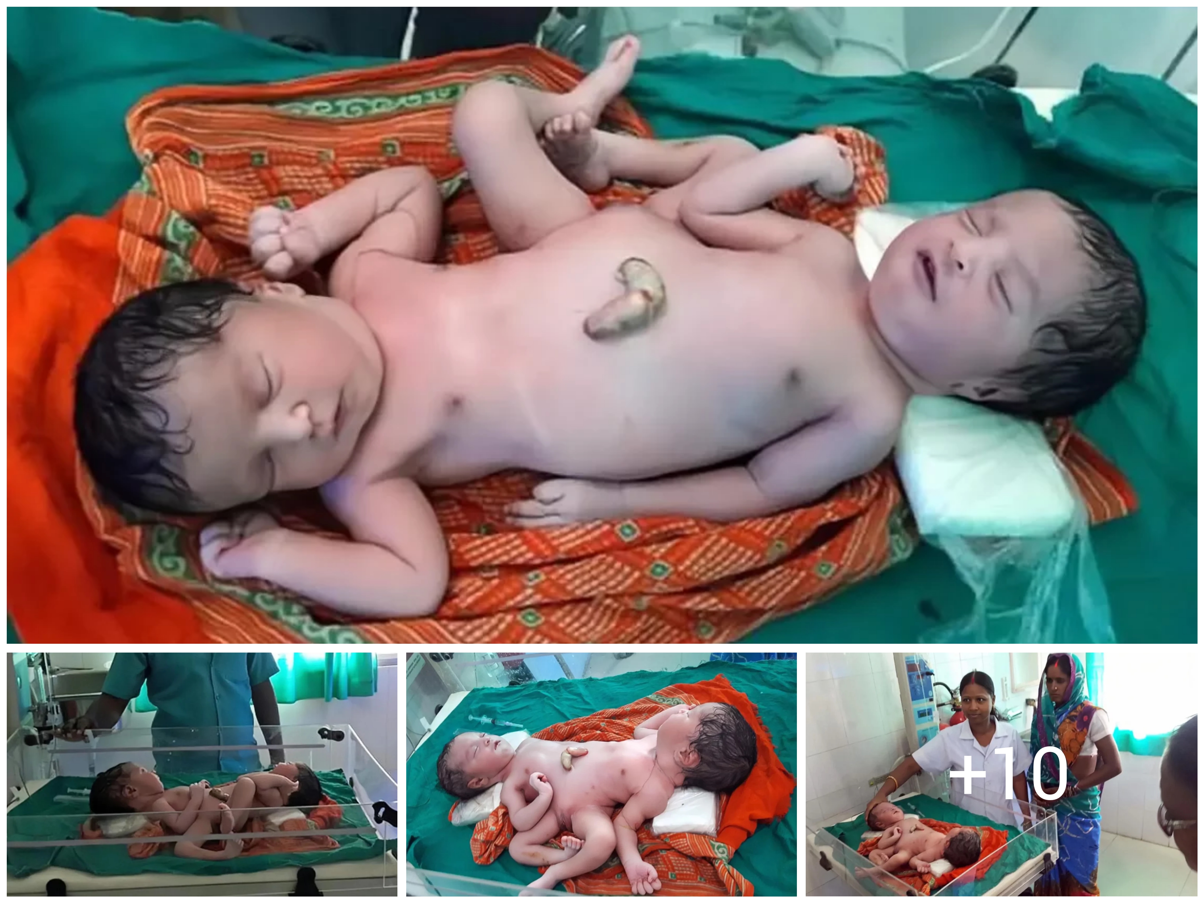 Conjoined Twins in India A Remarkable Story of Resilience and Adaptation