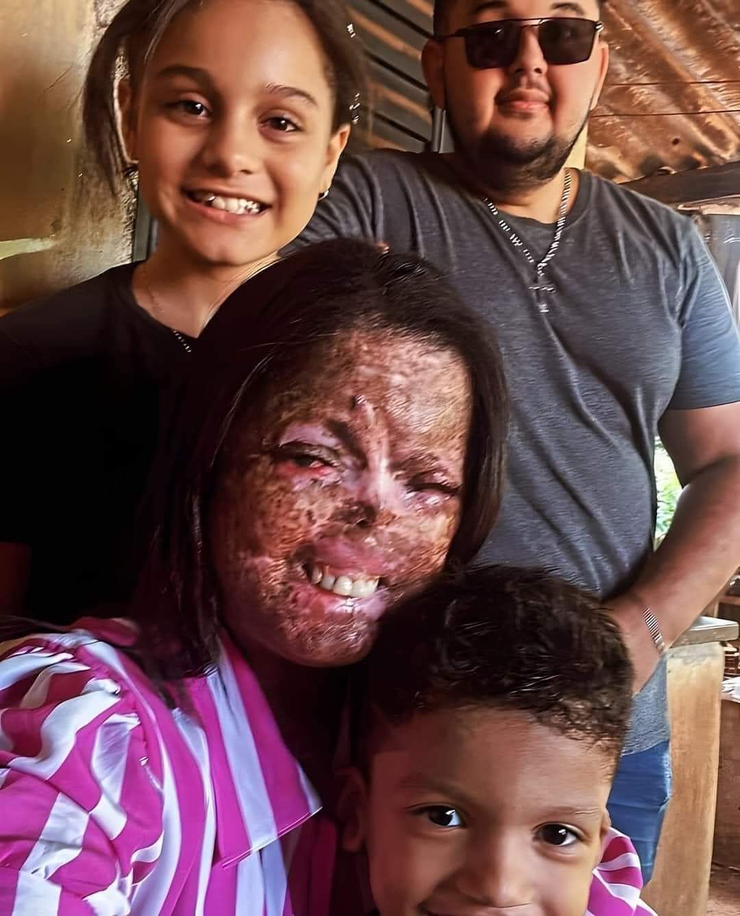 The Sweet Love of Family for a Mother with a Burned Face