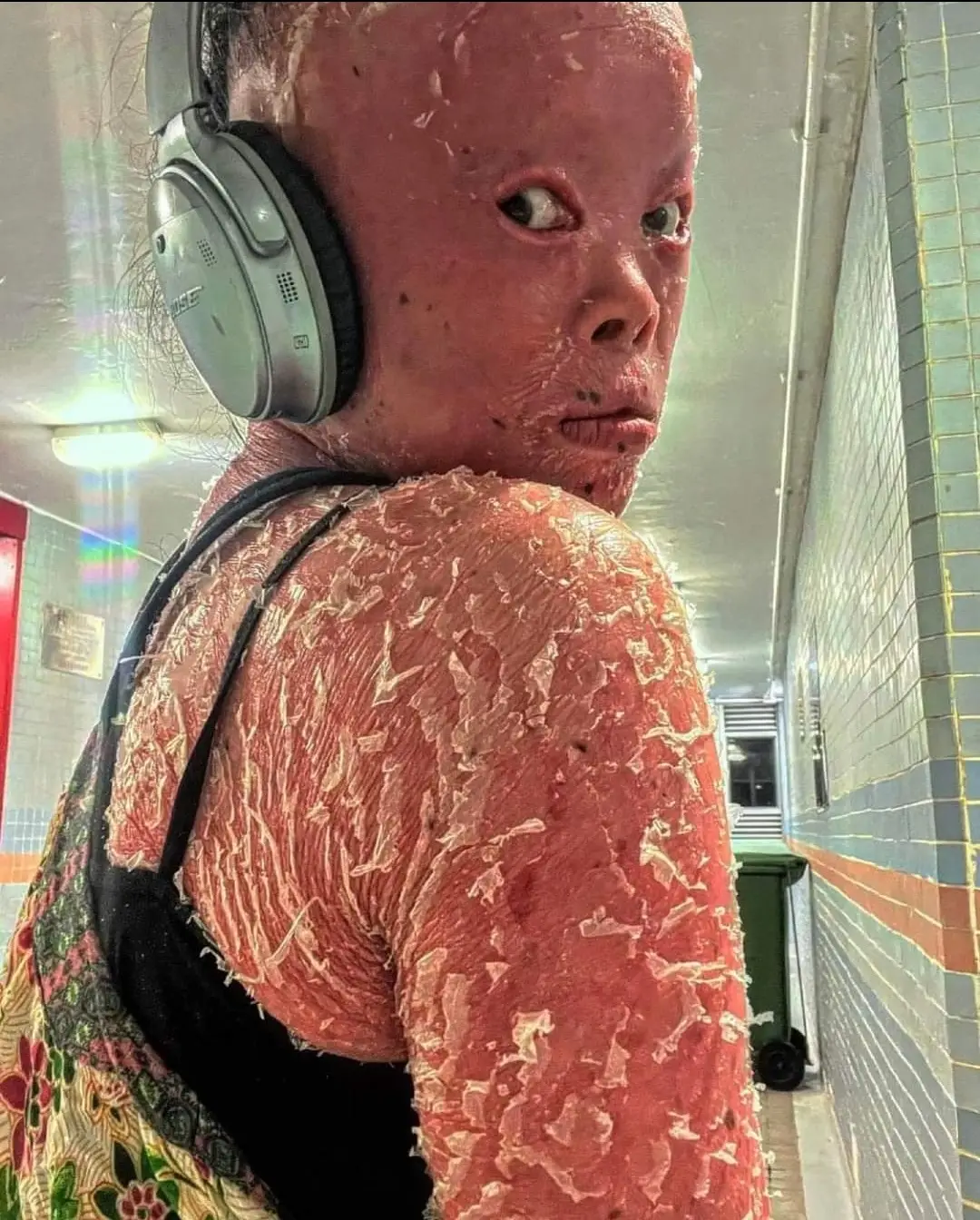 Girl with Psoriasis All Over Her Body: Understanding Symptoms and Treatments