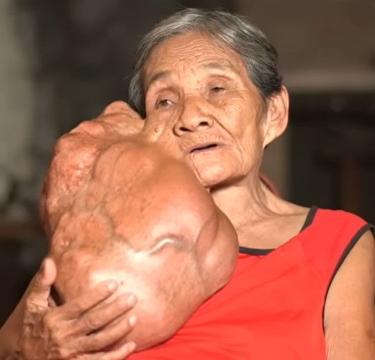 The Resilient Spirit: An Elderly Woman’s Journey with a Facial Tumor