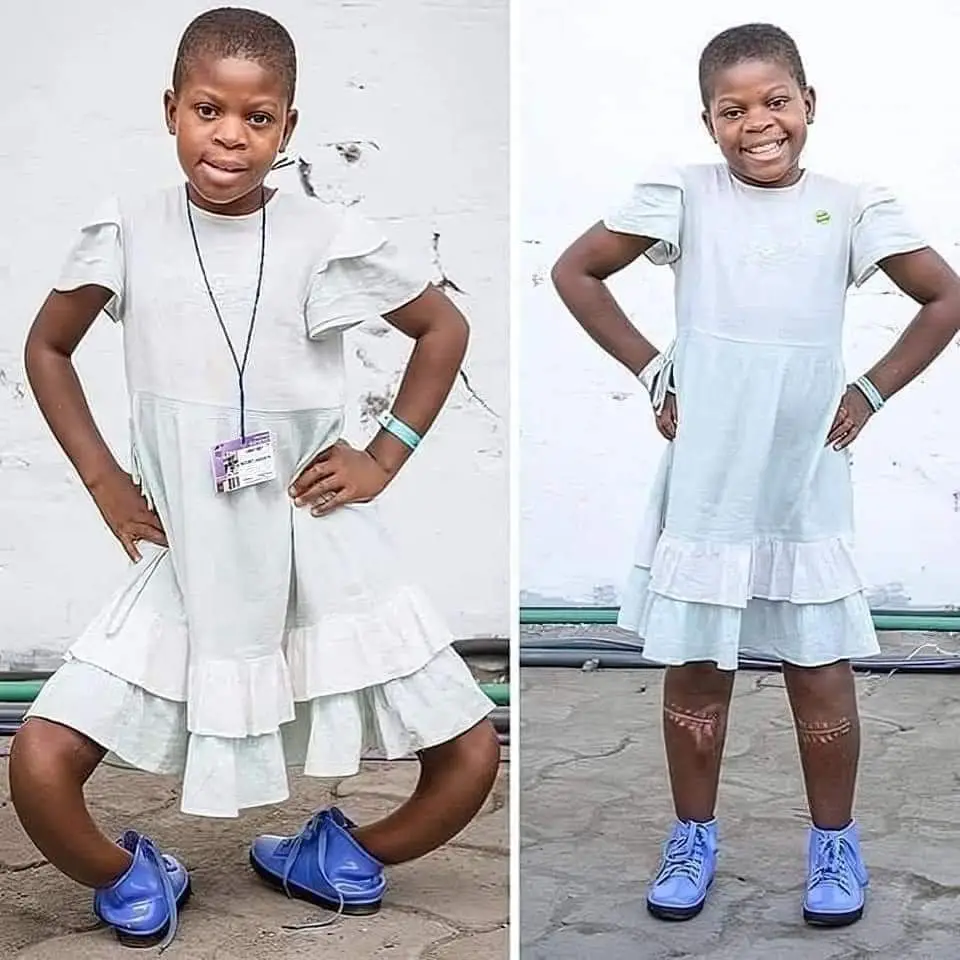 Successful Surgery for Girl with C-Shaped Legs A Medical Miracle