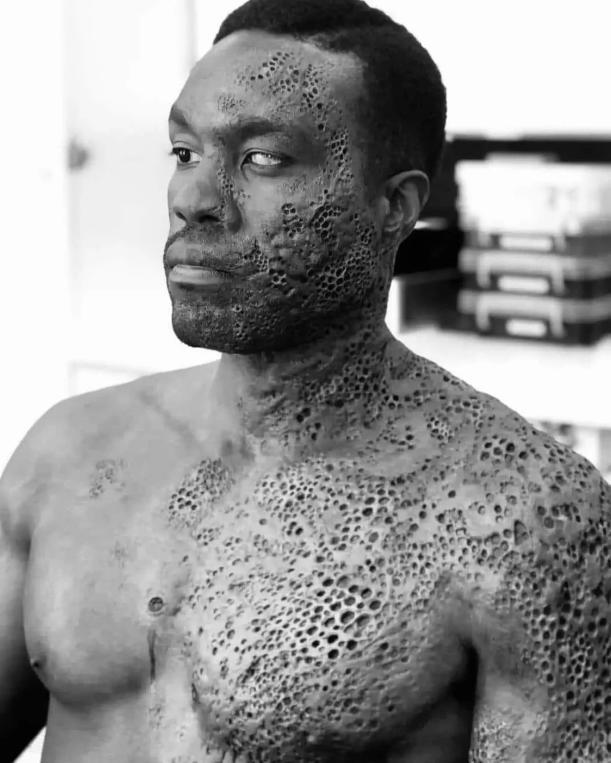 The Extraordinary Boy with Honeycomb-Like Pockmarks on His Skin