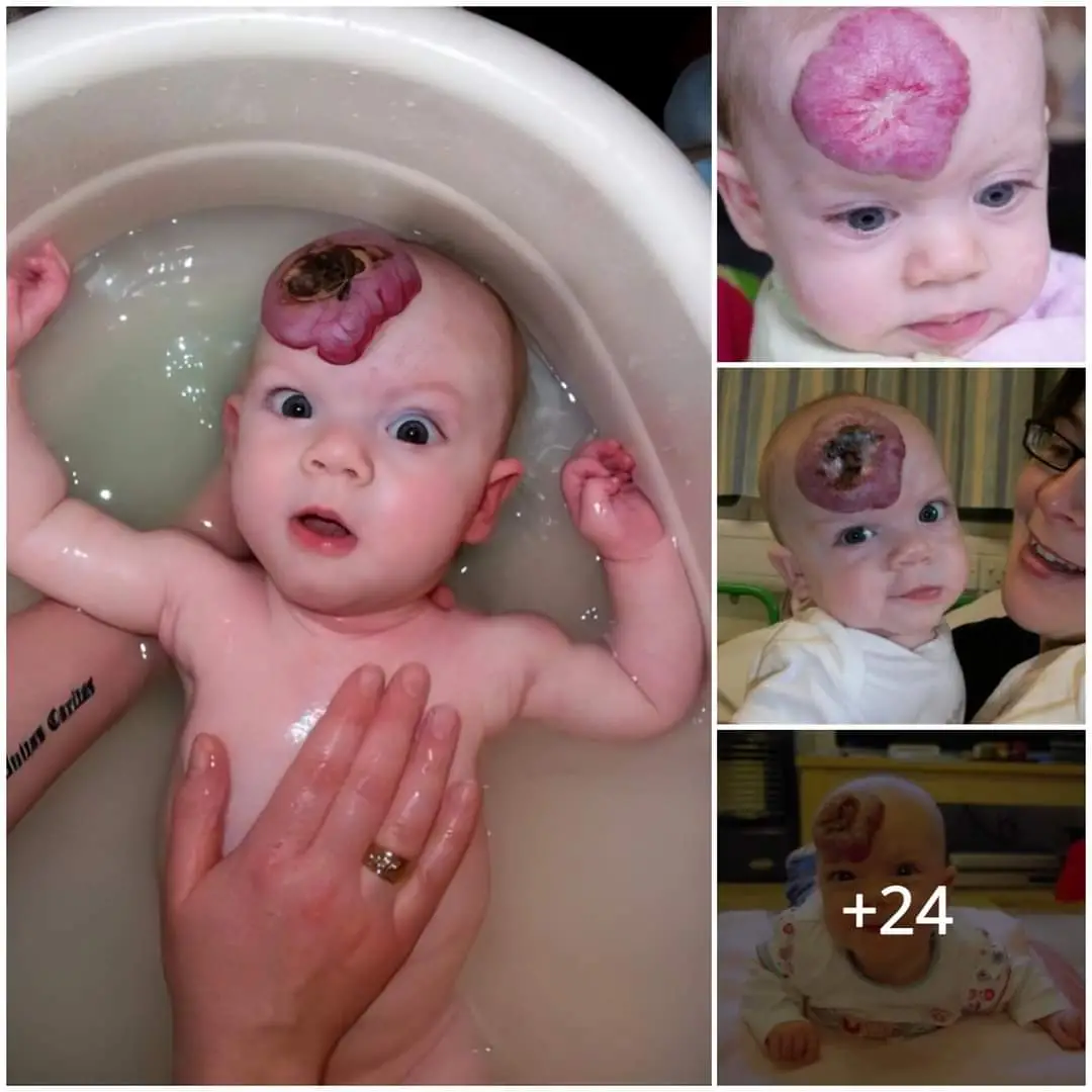 The Mysterious Case of the Baby with a Flower-Shaped Scar on the Forehead