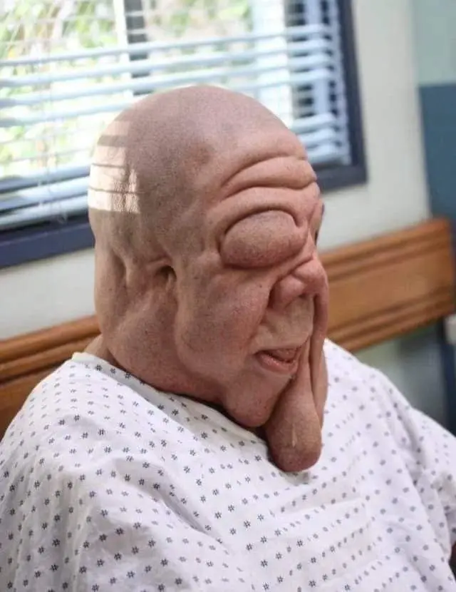 The Remarkable Story of the Man with Sagging Tumors on His Face