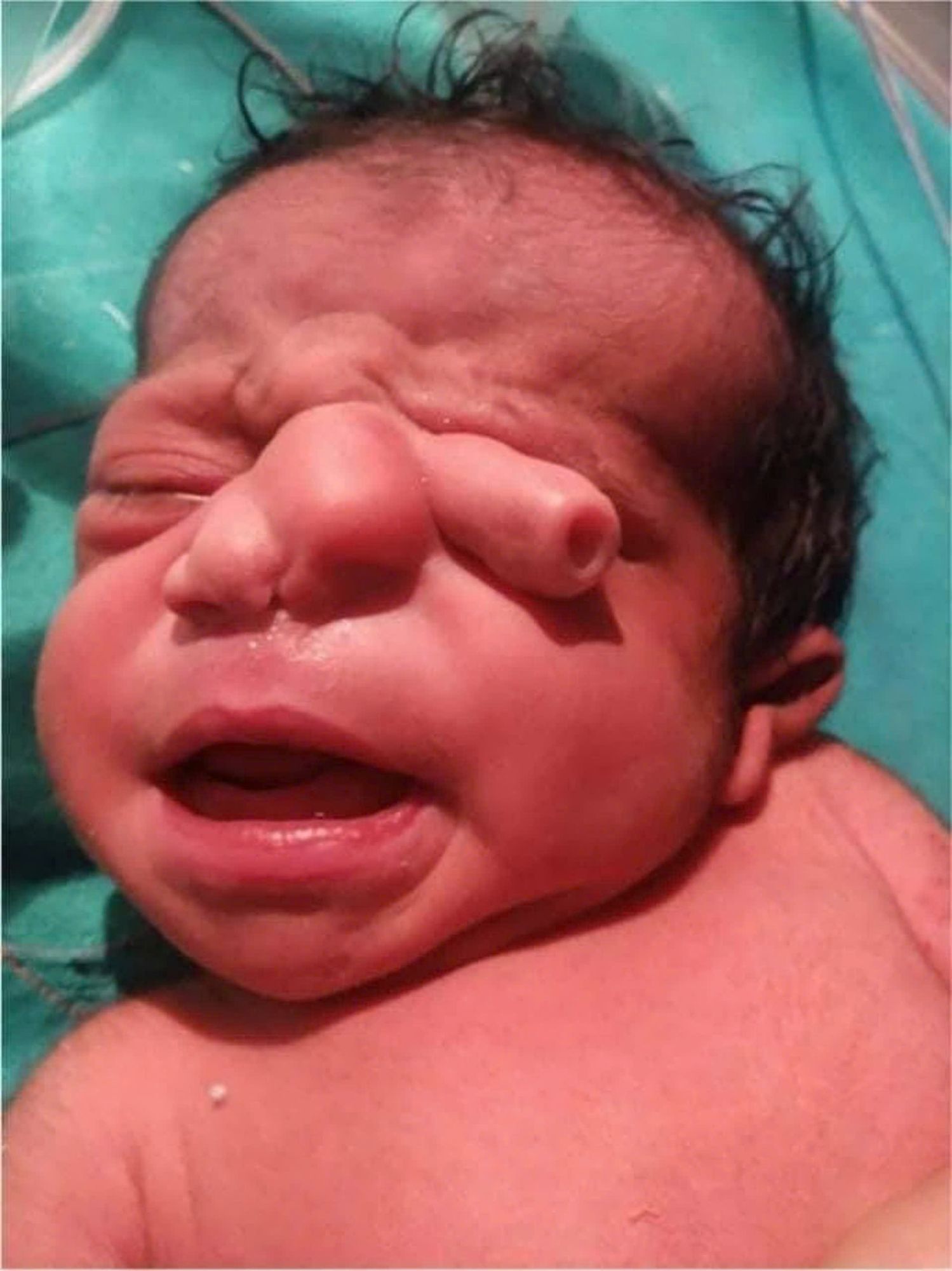 Simultaneous Branchial Cleft Anomalies and Congenital Malformations: A Unique Case Report