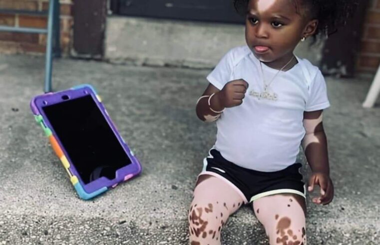 Embracing Beauty in Diversity: The Inspiring Journey of a Little Girl with Vitiligo