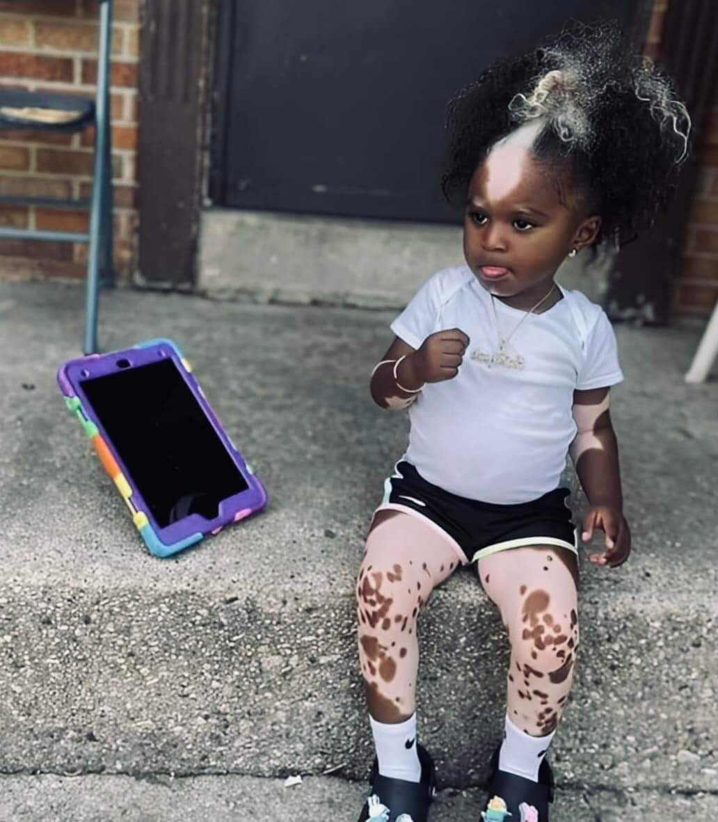 Embracing Beauty in Diversity: The Inspiring Journey of a Little Girl with Vitiligo