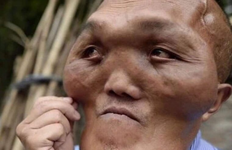 A Face of Resilience: The Story of a Man Living with a Disfiguring Illness